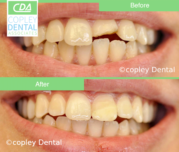 CASE 42: Emergency Dentist – Broken Tooth
