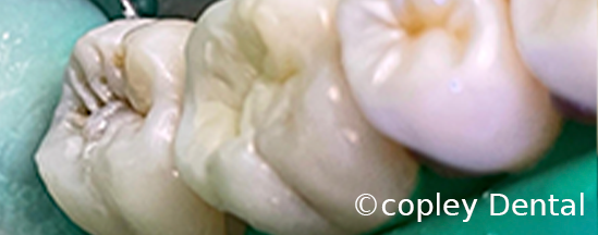 CASE 43: Tooth-Colored Dental Fillings - After