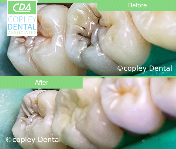 CASE 43: Tooth-Colored Dental Fillings