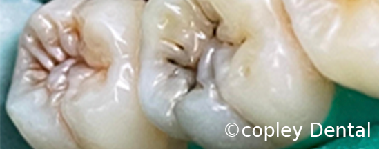 CASE 43: Tooth-Colored Dental Fillings - Before