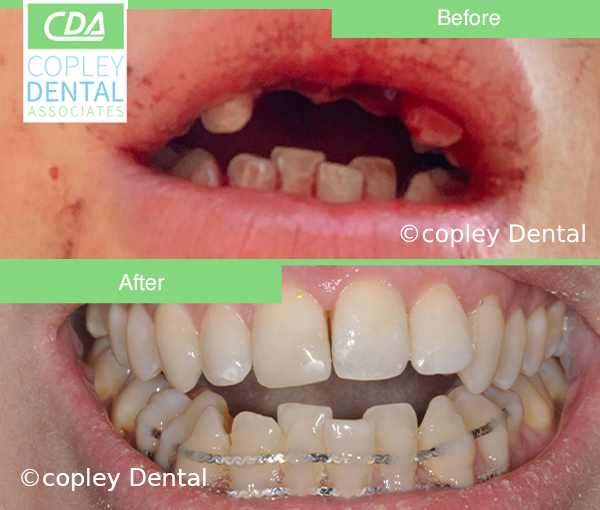CASE 50: Fractured Tooth - Reimplantation