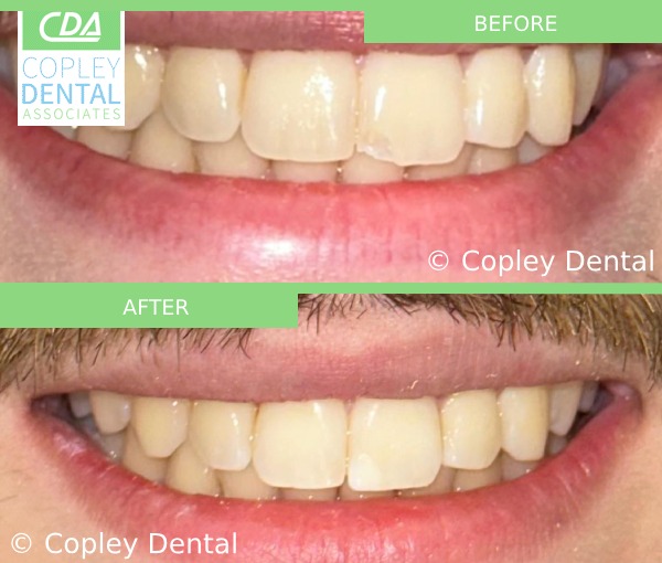 CASE 52: Fractured Tooth