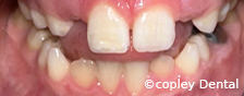 CASE 53: Fractured Tooth - After