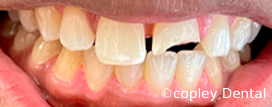 CASE 61: Fractured Tooth - Before