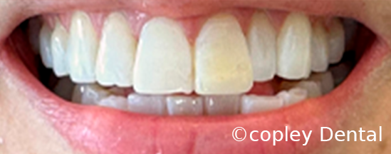 CASE 62: Fractured Tooth - After