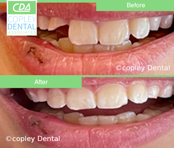 CASE 63: Fractured Tooth