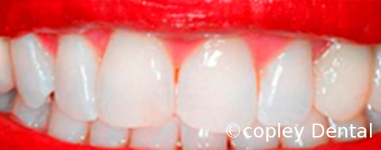 CASE 65: Cosmetic Dentistry – Teeth Whitening - After
