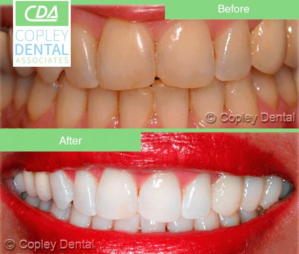CASE 65: Cosmetic Dentistry – Teeth Whitening