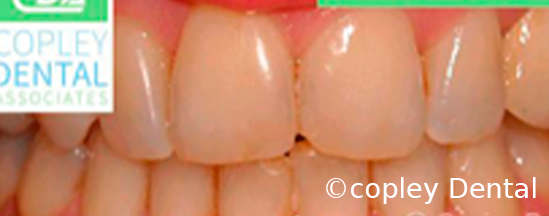 CASE 65: Cosmetic Dentistry – Teeth Whitening - Before