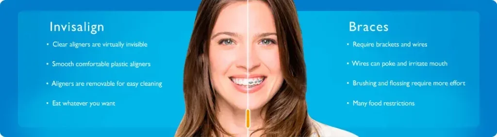 Invisalign clear aligners treatment process