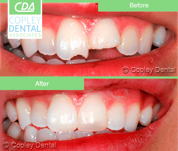 CASE 11: Emergency Dentist – Chipped Tooth