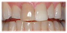CASE 12: Veneers – Stained Teeth - Before