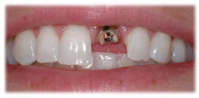CASE 13: Emergency Treatment – Fractured Tooth - Before