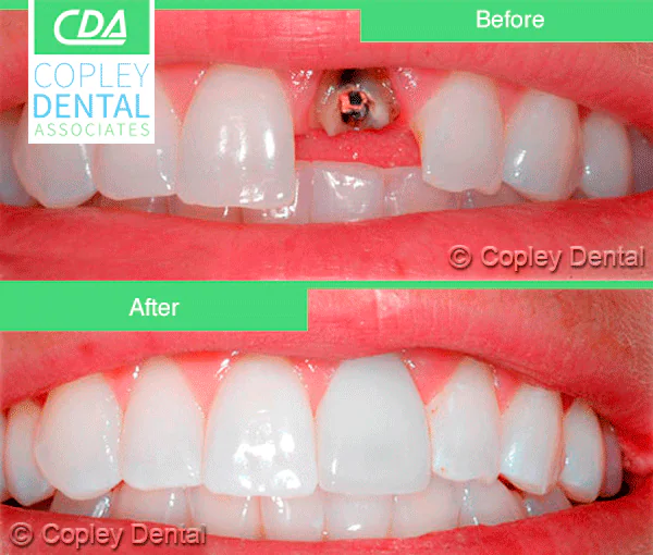 CASE 13: Emergency Treatment – Fractured Tooth