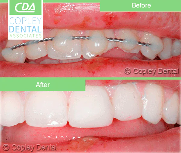 CASE 14: Dental Trauma- Broken Teeth