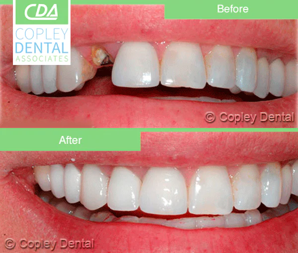 CASE 16: Broken Fractured Tooth