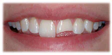 CASE 18: Broken Fractured Tooth - Before