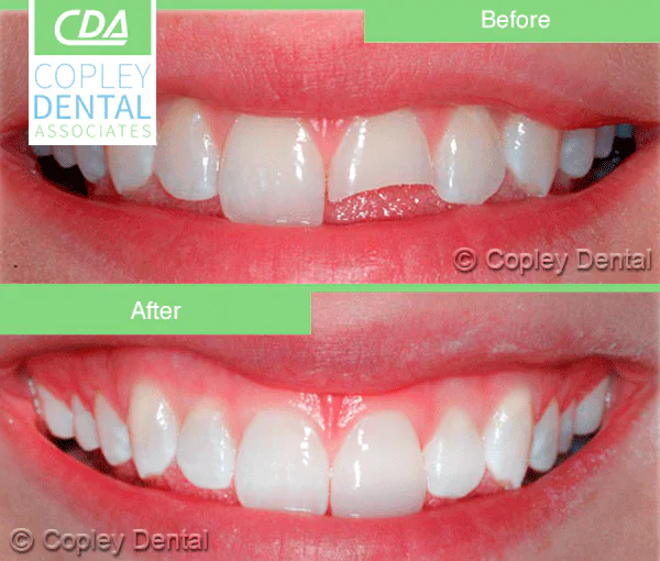 CASE 18: Broken Fractured Tooth