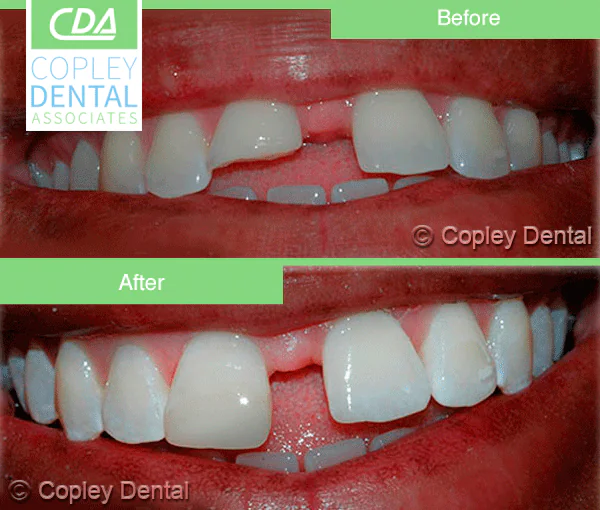CASE 21: Emergency Dentist – Fractured Tooth