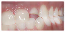 CASE 25: Emergency Treatment – Fractured Tooth - Before
