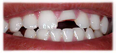 CASE 27: Emergency Treatment – Fractured Tooth - Before