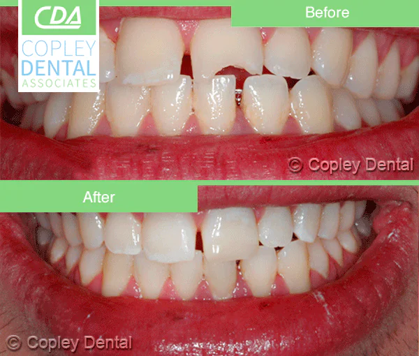 CASE 29: Emergency Treatment – Broken Teeth