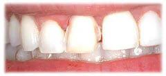 CASE 30: Cosmetic Lengthening - Before