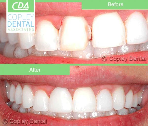 CASE 30: Cosmetic Lengthening