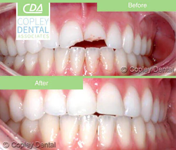 CASE 33: Emergency Treatment – Fractured Tooth