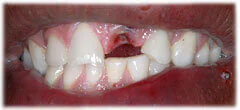 CASE 34: Emergency Treatment – Fractured Tooth - Before