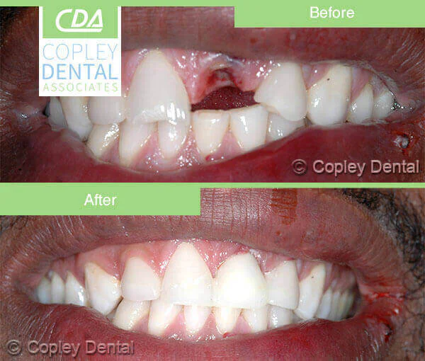 CASE 34: Emergency Treatment – Fractured Tooth