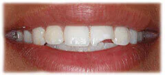 CASE 36: Emergency Treatment – Broken Tooth - Before