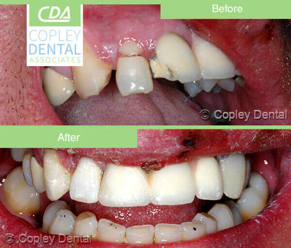 CASE 37: Broken Fractured Tooth