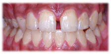 CASE 4: Cosmetic Dentistry–Cleaning–Whitening - After