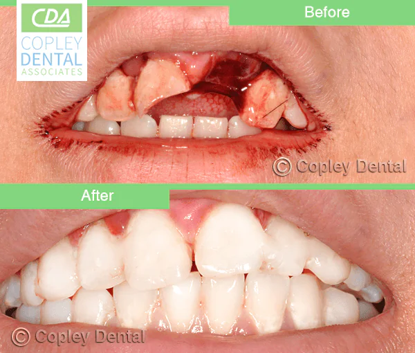 CASE 41: Emergency Treatment – Fractured Tooth