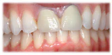 CASE 6: Cosmetic Dentistry – Porcelain Crowns - Before