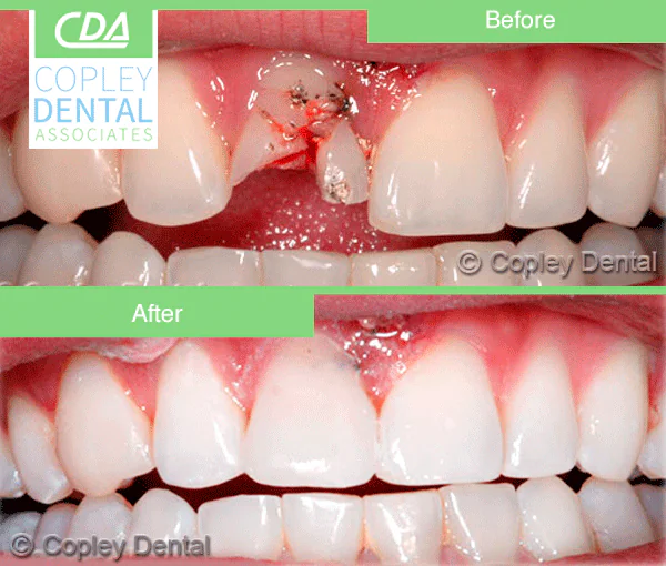 CASE 7: Emergency Treatment – Fractured Tooth