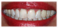 CASE 8: Cosmetic Dentistry – Teeth Whitening - After