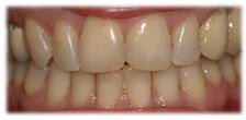 CASE 8: Cosmetic Dentistry – Teeth Whitening - Before