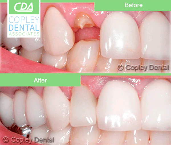 CASE 9: Emergency Treatment – Fractured Tooth