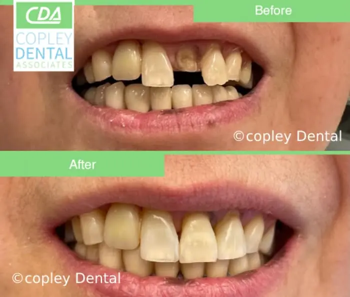 CASE 51: Emergency Visit – Fractured Tooth
